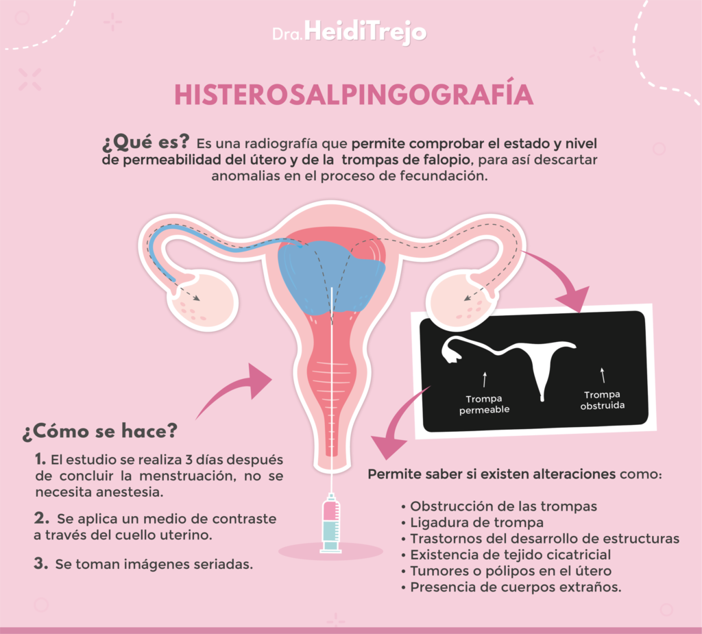 estudio de histerosalpingografía