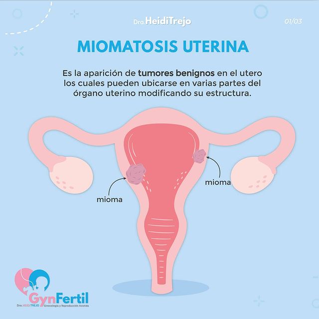 que es la miomatosis uterina