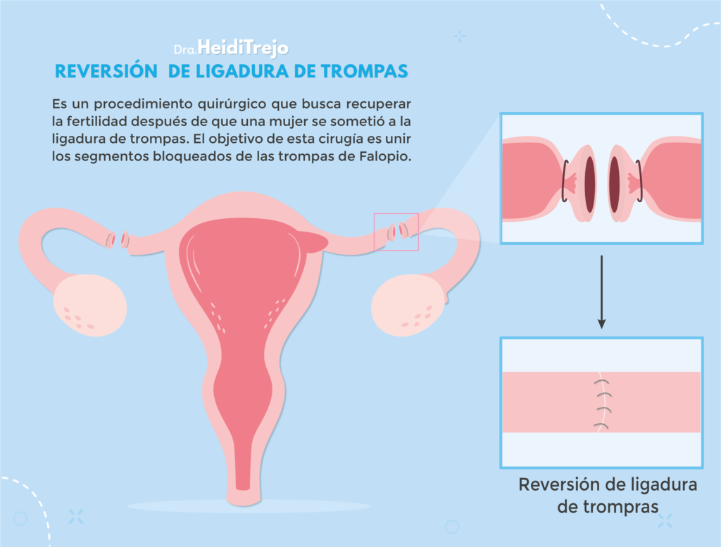 recanalizacion de trompas de falopio