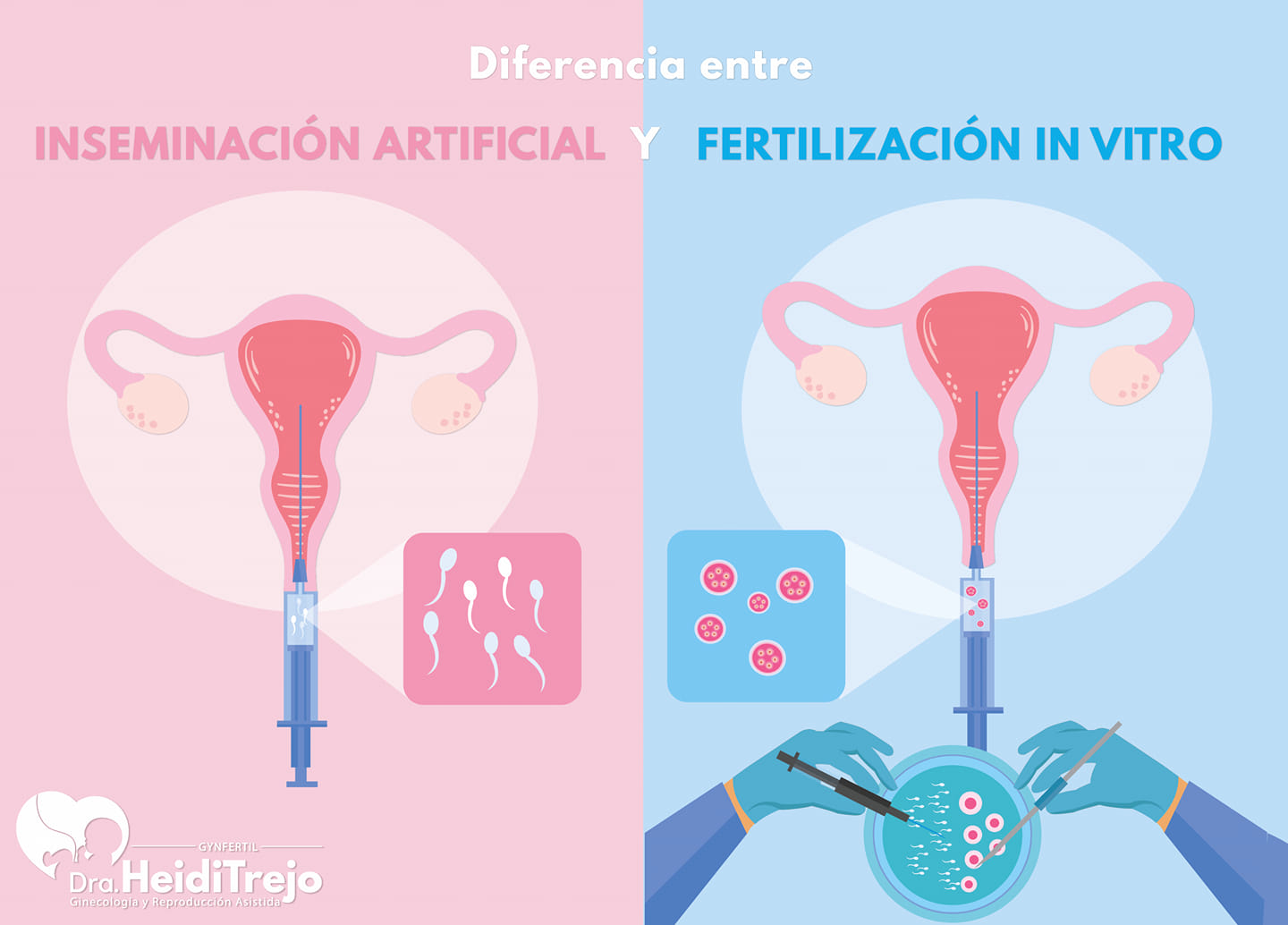 Inseminacion vs FIV